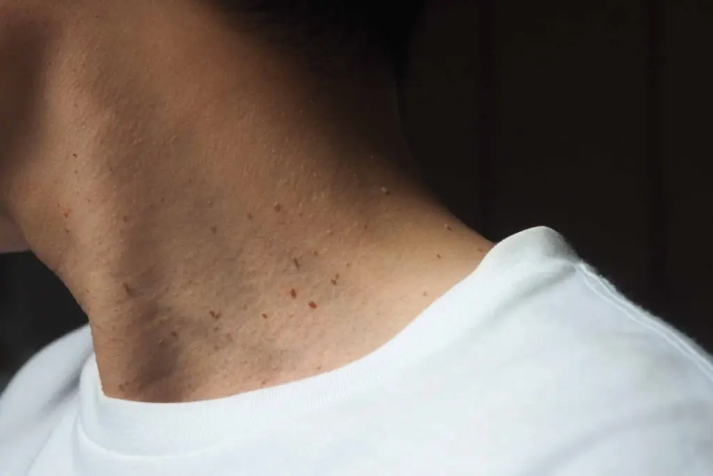 Say Goodbye To Skin Tags And More With Lamprobe!